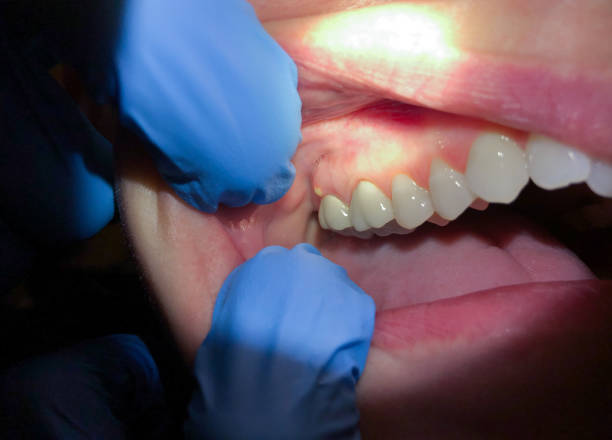 Best Emergency Denture Repair in Hometown, PA